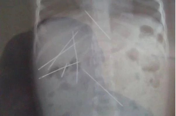 radiografia degli aghi trovati nel corpo di una bambina