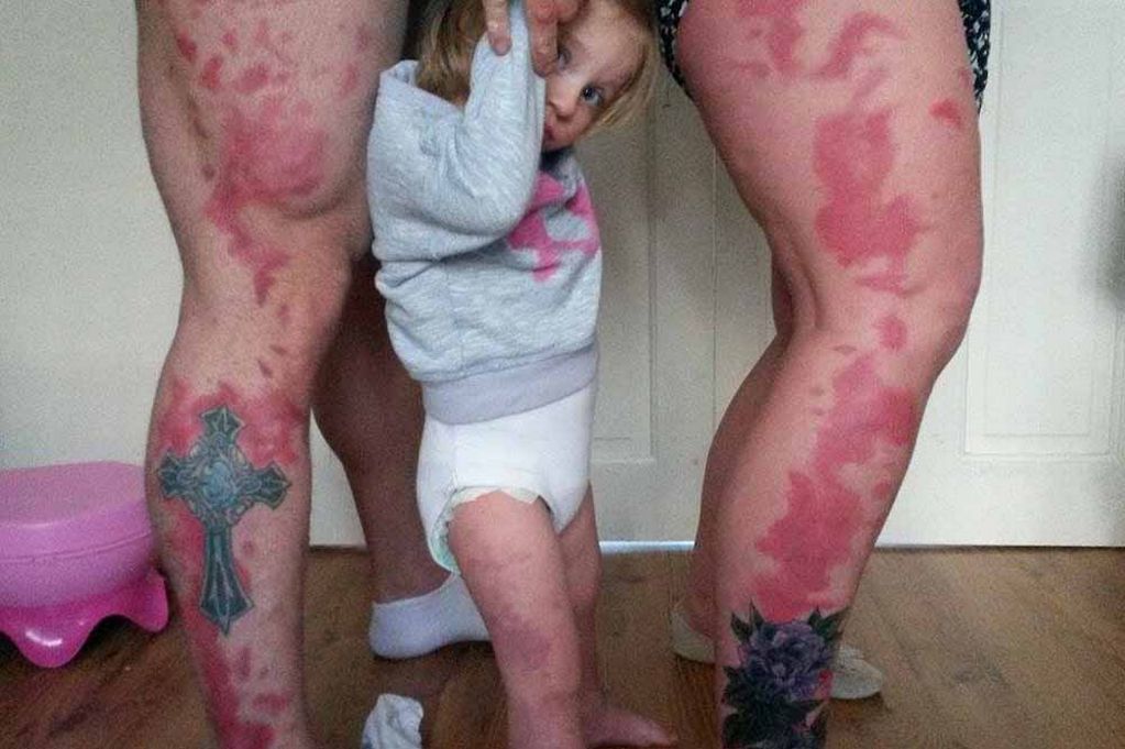 Genitori fanno il tatuaggio della voglia della figlia per dimostrare che non è diversa