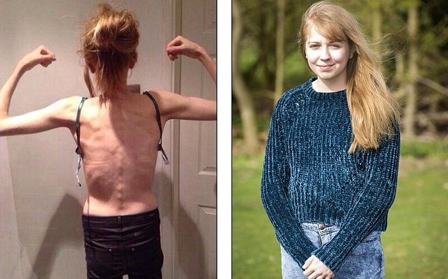 La figlia adolescente è anoressica, lei posta le foto sul web