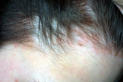 Prurito Alla Testa Tutte Le Possibili Cause Nanopress