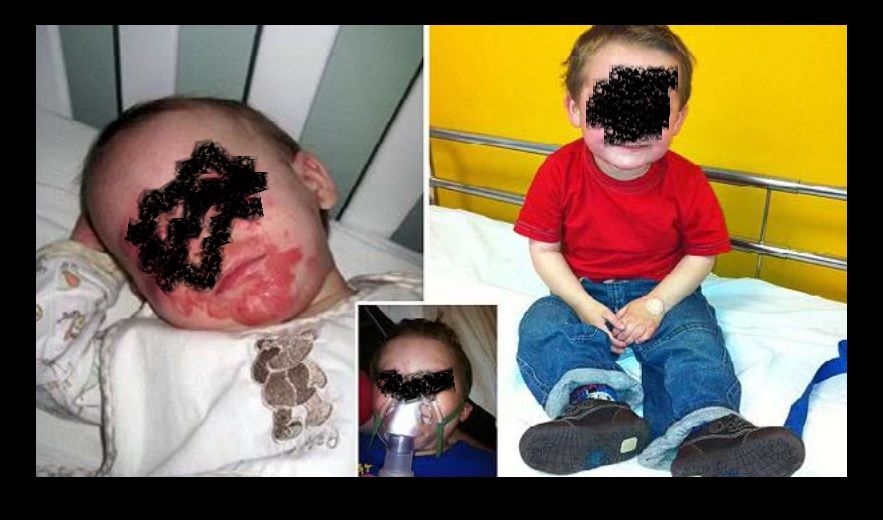 Bimbo malato di eczema chiede di morire nel giorno del suo quinto compleanno