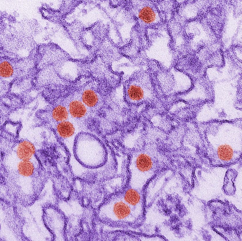 Zika, primo caso di mocrocefalia in Spagna