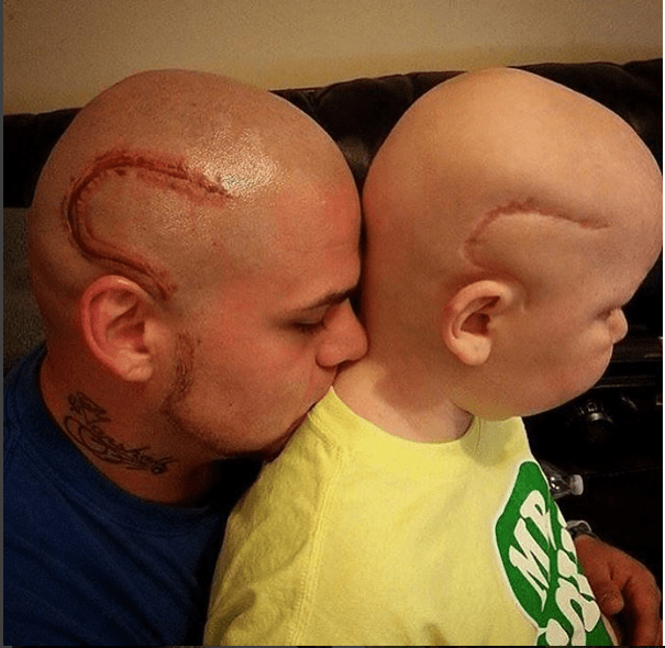 Papà si tatua sulla testa la stessa cicatrice del figlio operato al cervello