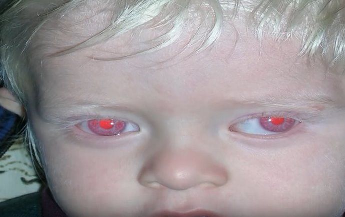 I 10 Bambini Con Un Colore Degli Occhi Unico Al Mondo