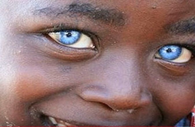 I 10 Bambini Con Un Colore Degli Occhi Unico Al Mondo