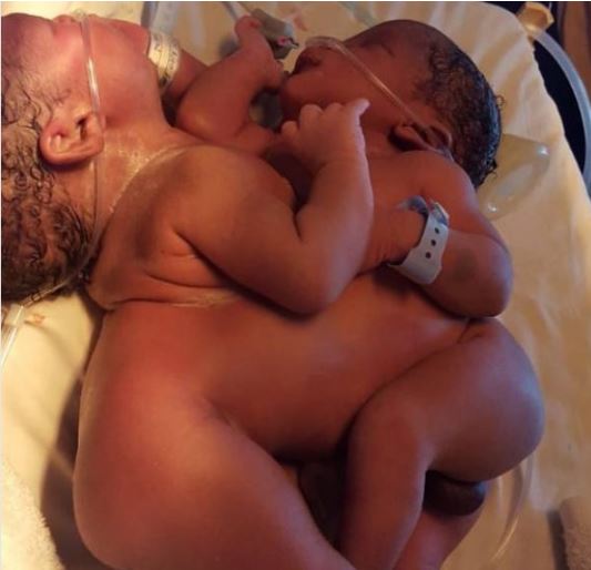 Nigeria: gemelli siamesi nati con parto cesareo, hanno il fegato in comune