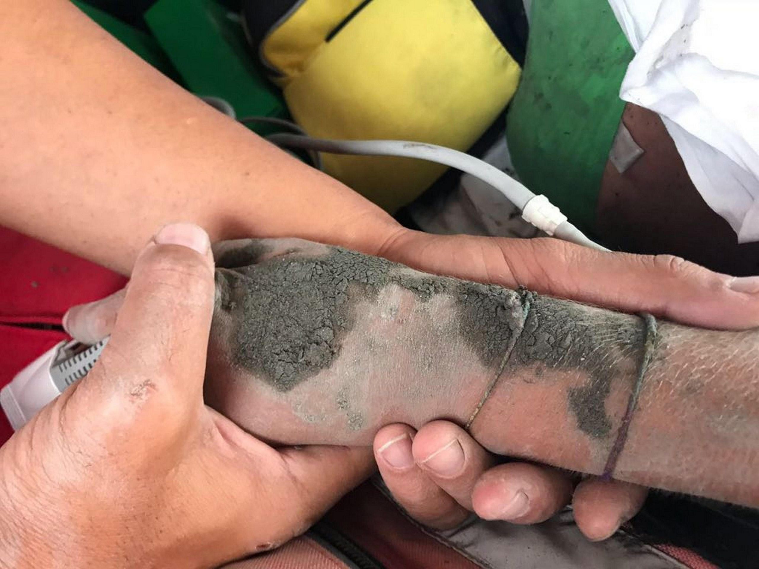 La mano di Chiara, il simbolo della tragedia del Pollino salvata dai genitori che le hanno fatto da scudo