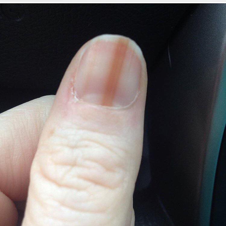 Scopre il melanoma all'unghia dopo la manicure in gel