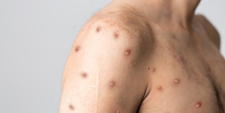 Il vaiolo delle scimmie