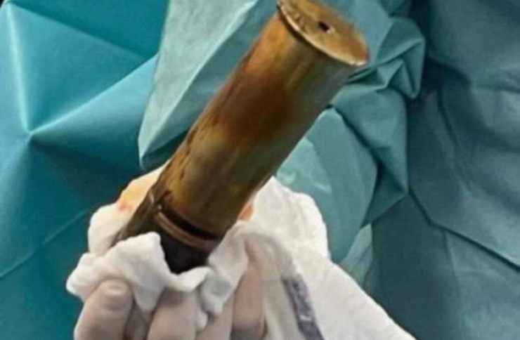 Proiettile estratto dal retto dell'88enne