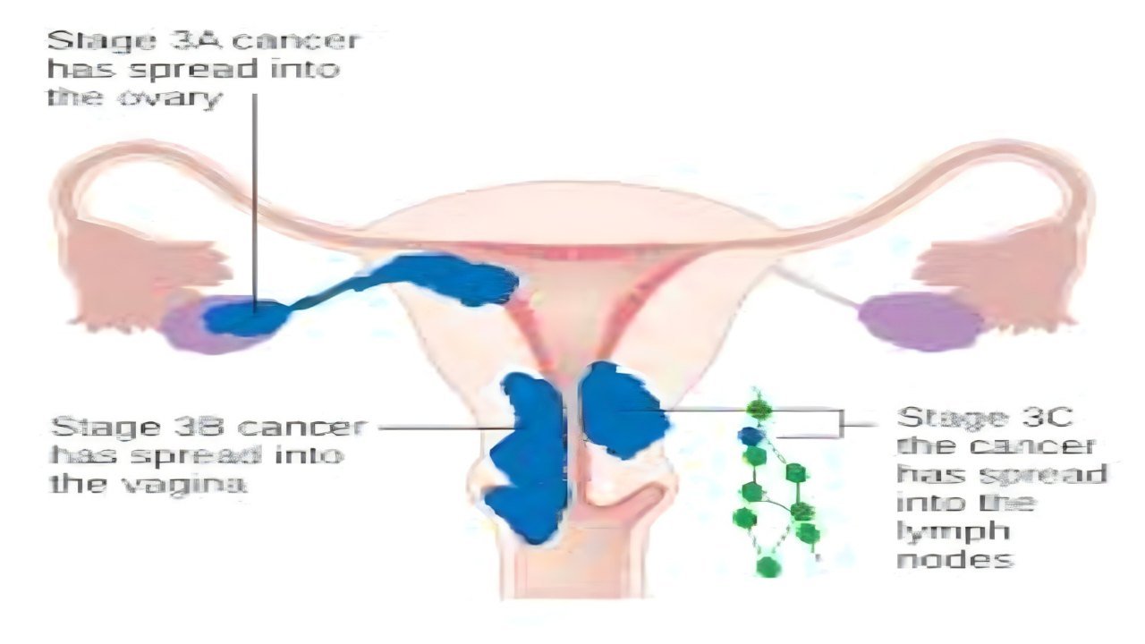 Tumore dell'endometrio 