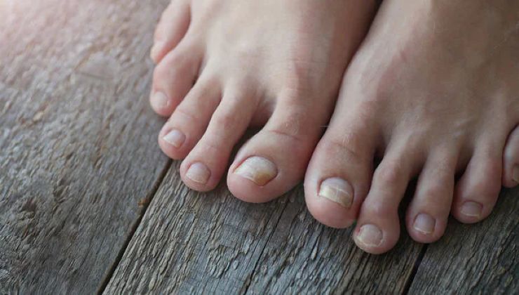 hongos en las uñas de los pies