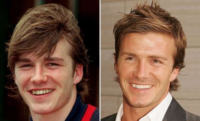 Denti di David Beckham prima e dopo