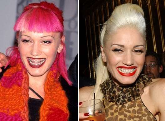 Denti di Gwen Stefani prima e dopo