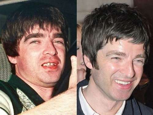 Denti di Noel Gallagher prima e dopo