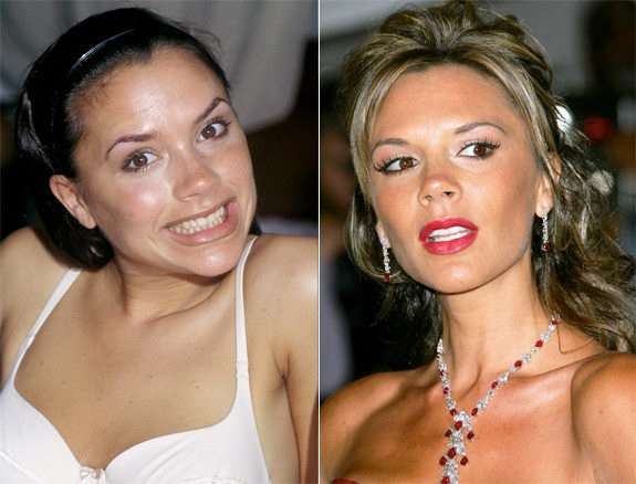 Denti di Victoria Beckham prima e dopo